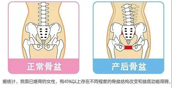 骨盆修復真的有效果嗎？有必要做嗎？(圖1)